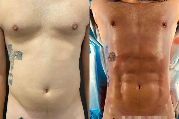 Ex BBB Caio Afiune Passa Por Lipo LAD Veja Antes E Depois